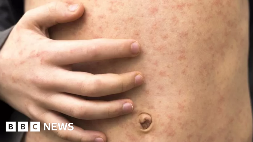 Students Urged To Be Careful About Measles After Outbreak In