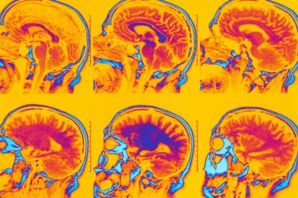 Brain Scans Identify Six Different Types Of Depression And Anxiety