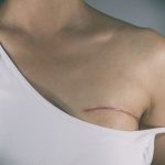 Double Mastectomy Doesn't Improve Breast Cancer Survival: Study